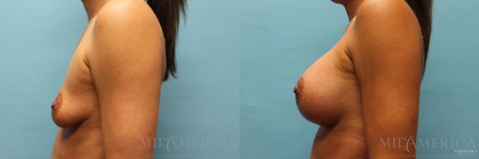 Before & After Breast Augmentation Case 101 View #3 View in St. Louis, MO