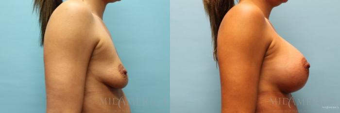Before & After Breast Augmentation Case 101 View #5 View in St. Louis, MO