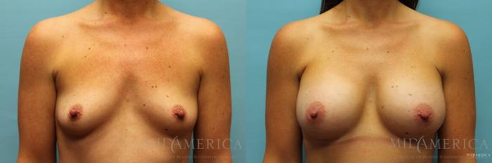 Before & After Breast Augmentation Case 103 View #1 View in St. Louis, MO