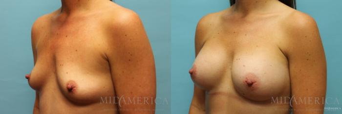 Before & After Breast Augmentation Case 103 View #2 View in St. Louis, MO