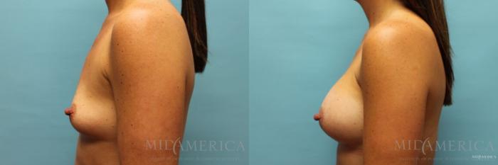 Before & After Breast Augmentation Case 103 View #3 View in St. Louis, MO