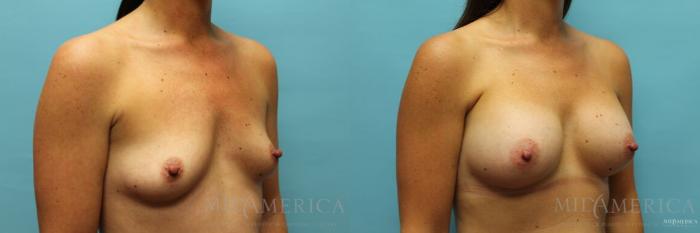Before & After Breast Augmentation Case 103 View #4 View in St. Louis, MO