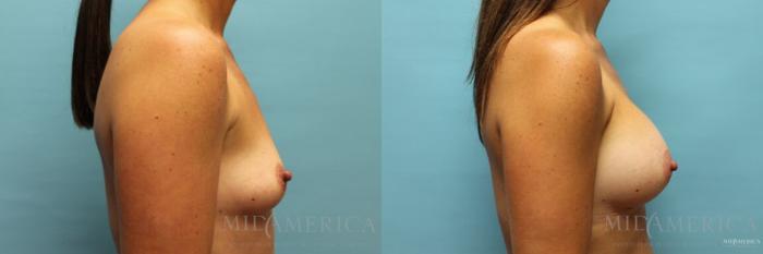 Before & After Breast Augmentation Case 103 View #5 View in St. Louis, MO