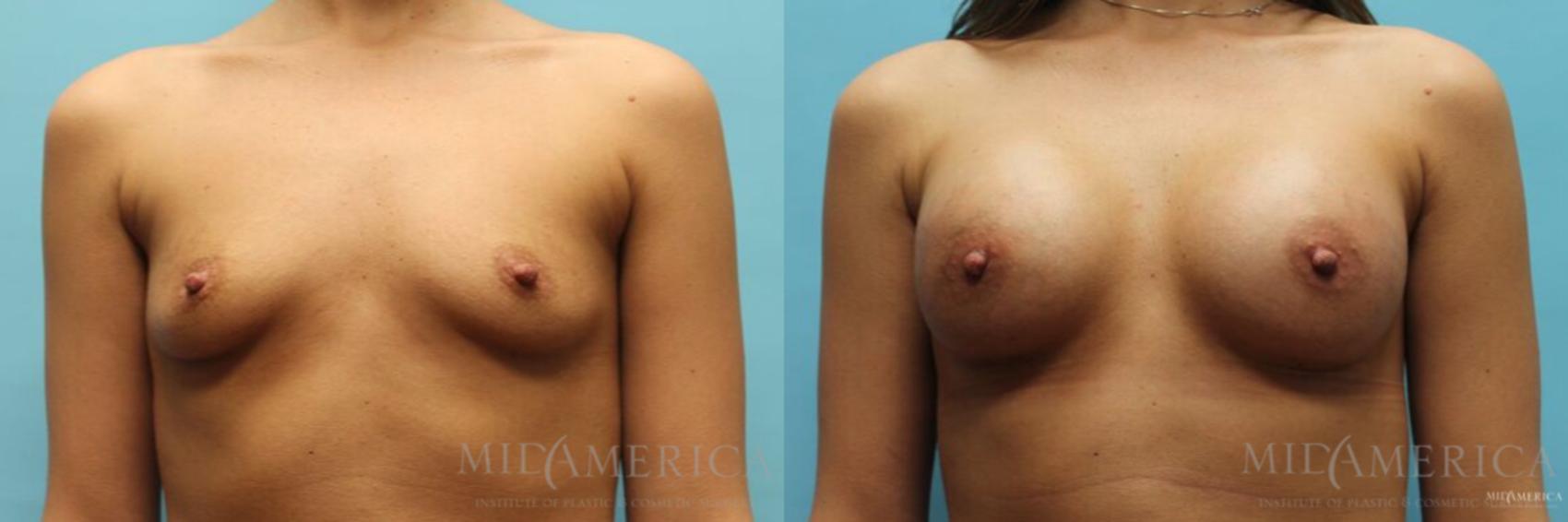 Before & After Breast Augmentation Case 104 View #1 View in Glen Carbon, IL