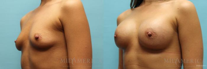Before & After Breast Augmentation Case 104 View #2 View in St. Louis, MO