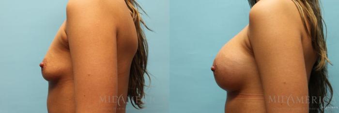 Before & After Breast Augmentation Case 104 View #3 View in St. Louis, MO