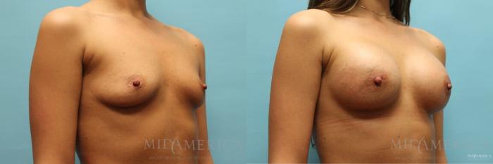 Before & After Breast Augmentation Case 104 View #4 View in St. Louis, MO