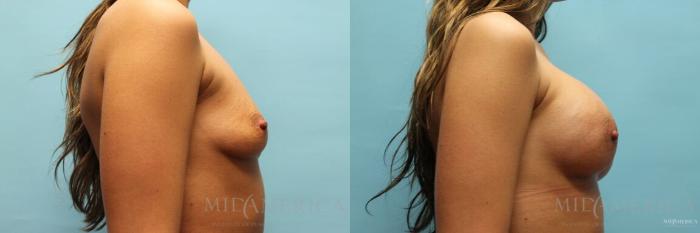 Before & After Breast Augmentation Case 104 View #5 View in St. Louis, MO