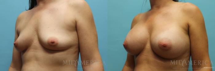 Before & After Breast Augmentation Case 105 View #2 View in Glen Carbon, IL