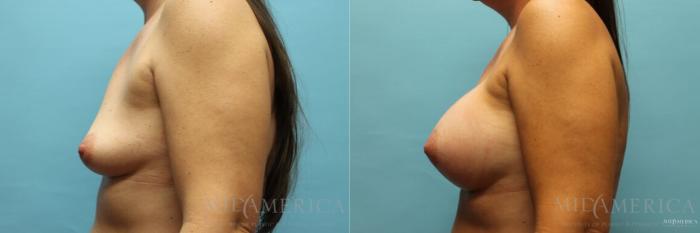 Before & After Breast Augmentation Case 105 View #3 View in Glen Carbon, IL