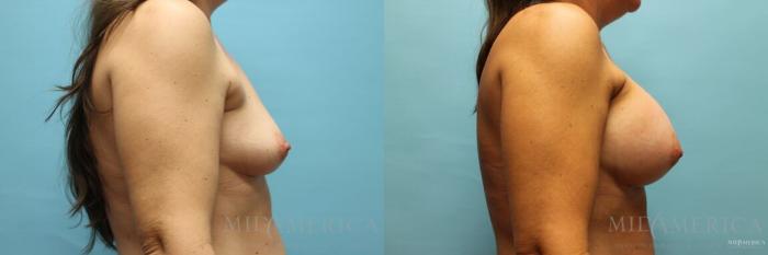Before & After Breast Augmentation Case 105 View #5 View in Glen Carbon, IL