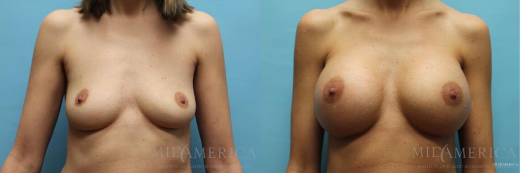 Before & After Breast Augmentation Case 106 View #1 View in Glen Carbon, IL