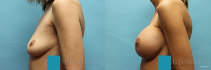 Before & After Breast Augmentation Case 106 View #3 View in St. Louis, MO