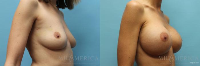 Before & After Breast Augmentation Case 106 View #4 View in St. Louis, MO