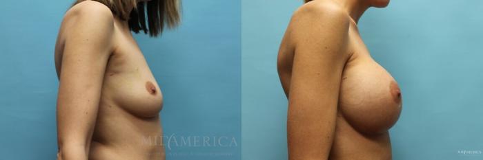 Before & After Breast Augmentation Case 106 View #5 View in St. Louis, MO