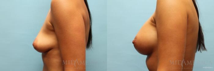 Before & After Breast Augmentation Case 108 View #3 View in St. Louis, MO