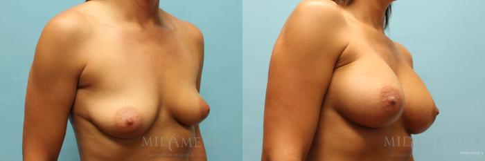 Before & After Breast Augmentation Case 108 View #4 View in St. Louis, MO