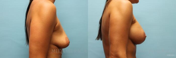 Before & After Breast Augmentation Case 108 View #5 View in St. Louis, MO