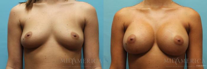 Before & After Breast Augmentation Case 110 View #1 View in St. Louis, MO