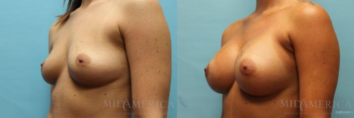 Before & After Breast Augmentation Case 110 View #2 View in St. Louis, MO