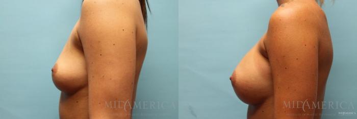 Before & After Breast Augmentation Case 110 View #3 View in St. Louis, MO