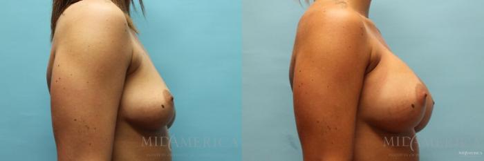Before & After Breast Augmentation Case 110 View #5 View in St. Louis, MO