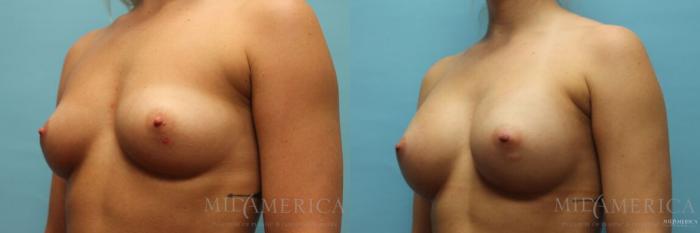 Before & After Breast Augmentation Case 111 View #2 View in St. Louis, MO