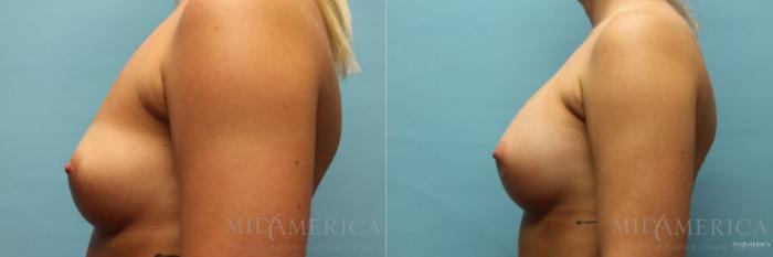 Before & After Breast Augmentation Case 111 View #3 View in St. Louis, MO