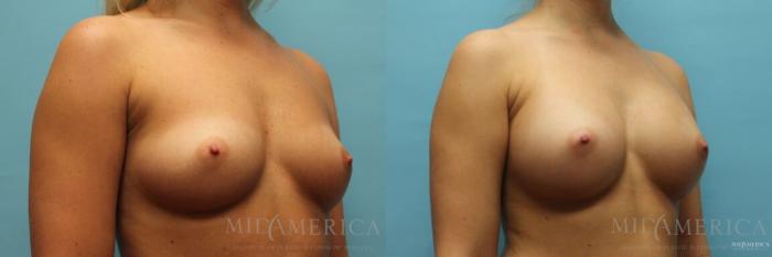 Before & After Breast Augmentation Case 111 View #4 View in St. Louis, MO