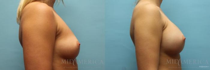 Before & After Breast Augmentation Case 111 View #5 View in St. Louis, MO
