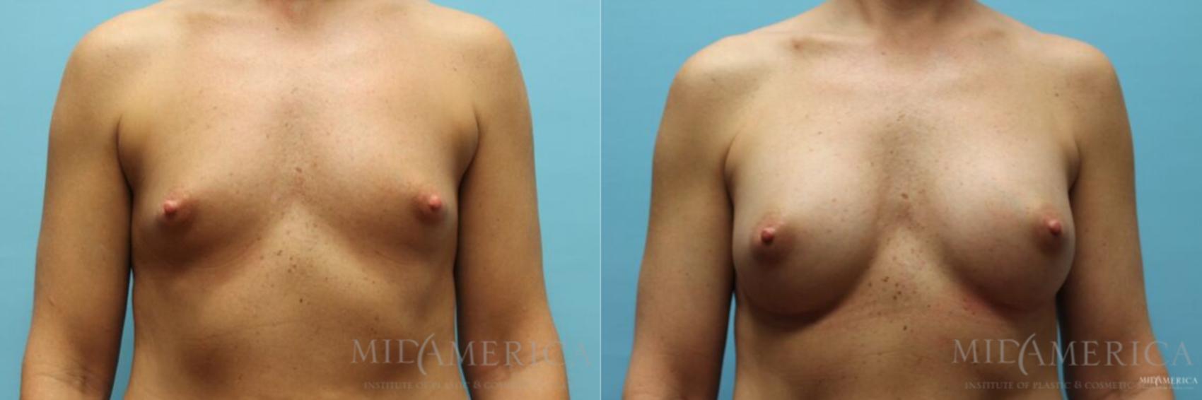 Before & After Breast Augmentation Case 115 View #1 View in Glen Carbon, IL