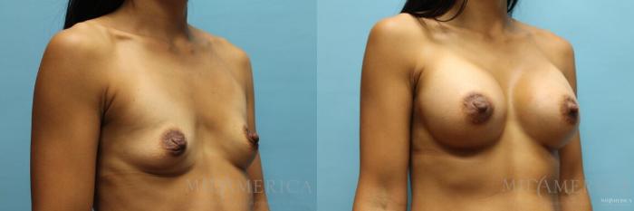 Before & After Breast Augmentation Case 119 View #4 View in St. Louis, MO