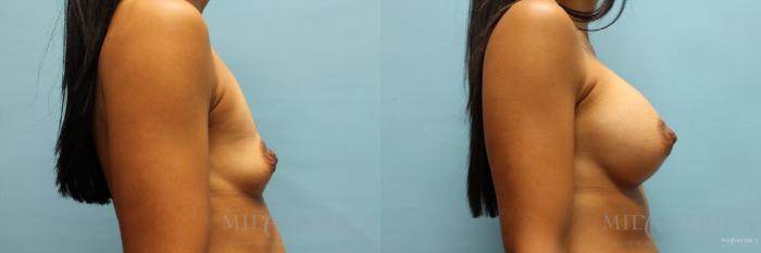 Before & After Breast Augmentation Case 119 View #5 View in St. Louis, MO