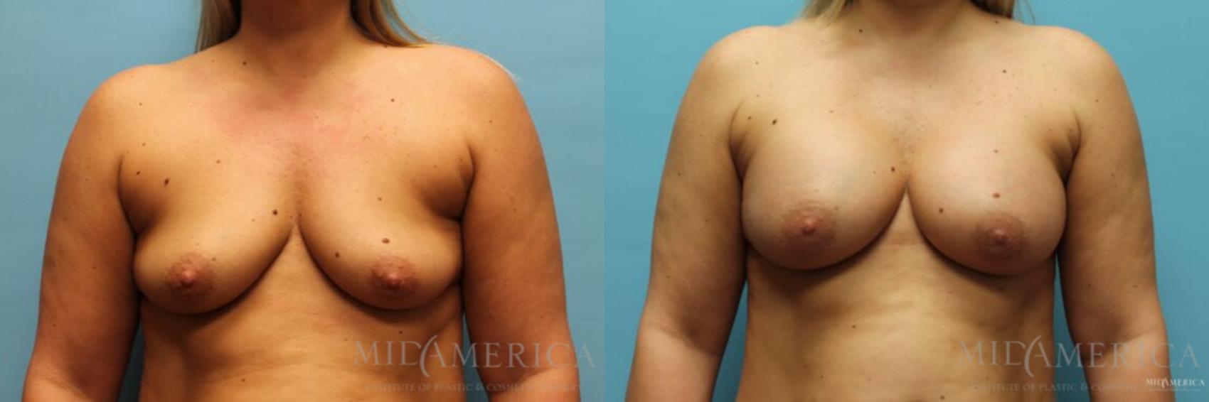 Before & After Breast Augmentation Case 120 View #1 View in Glen Carbon, IL