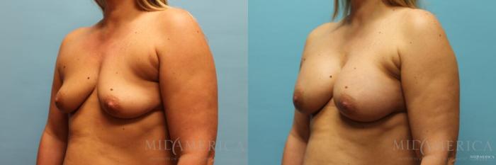 Before & After Breast Augmentation Case 120 View #2 View in Glen Carbon, IL