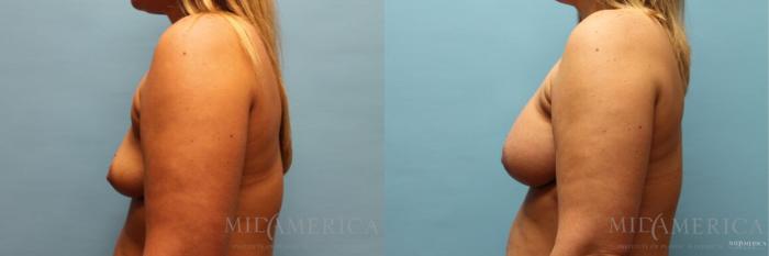 Before & After Breast Augmentation Case 120 View #3 View in Glen Carbon, IL