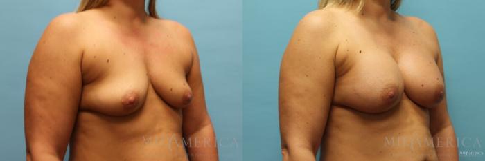 Before & After Breast Augmentation Case 120 View #4 View in Glen Carbon, IL