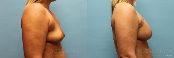 Before & After Breast Augmentation Case 120 View #5 View in Glen Carbon, IL
