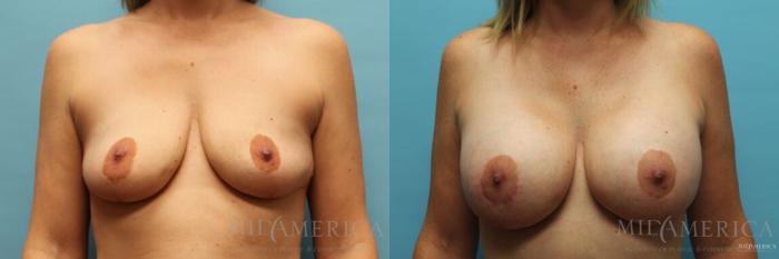 Before & After Breast Augmentation Case 121 View #1 View in Glen Carbon, IL