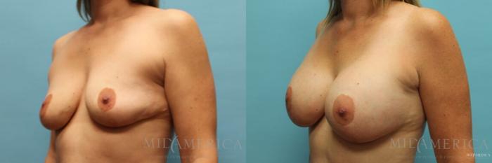 Before & After Breast Augmentation Case 121 View #2 View in St. Louis, MO