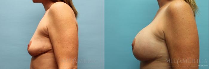 Before & After Breast Augmentation Case 121 View #3 View in St. Louis, MO