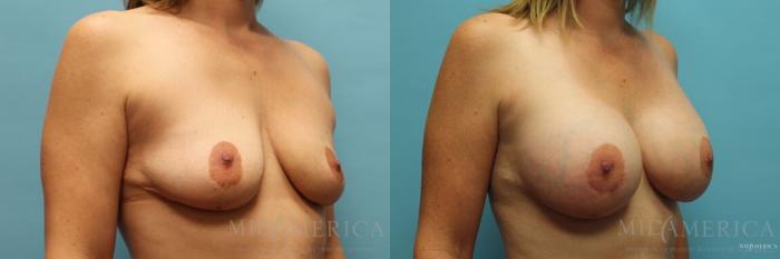 Before & After Breast Augmentation Case 121 View #4 View in St. Louis, MO