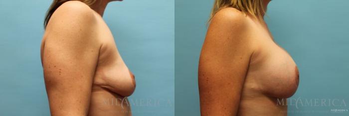 Before & After Breast Augmentation Case 121 View #5 View in St. Louis, MO