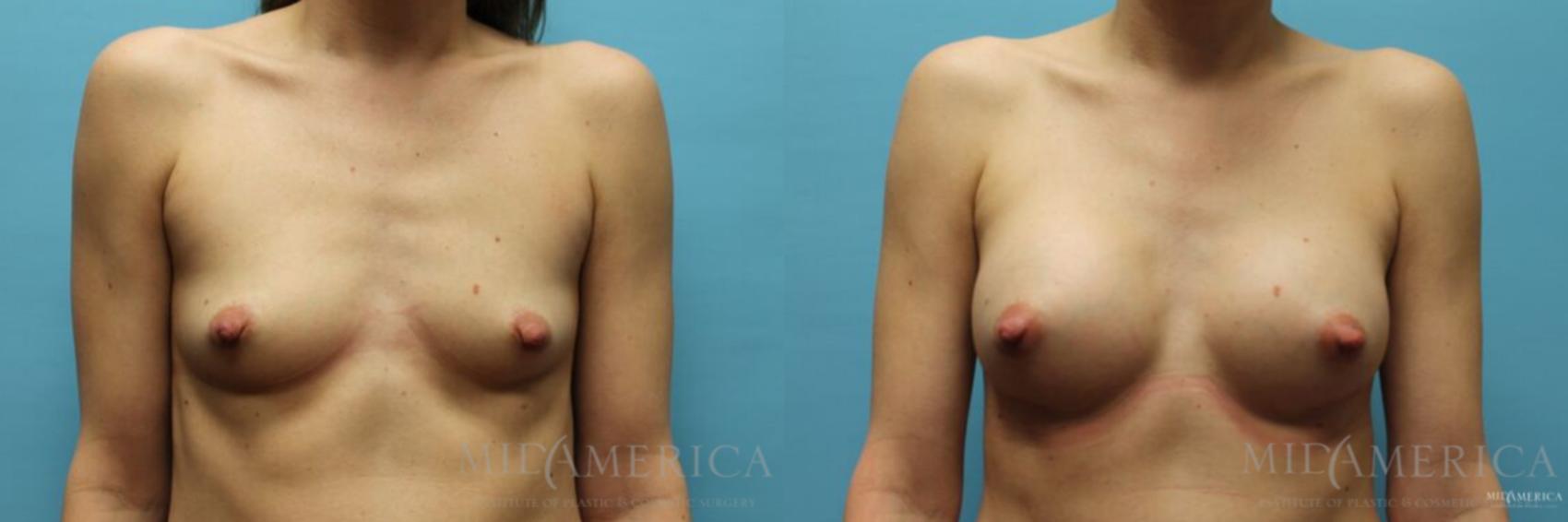 Before & After Breast Augmentation Case 124 View #1 View in Glen Carbon, IL