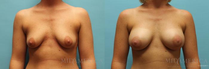 Before & After Breast Augmentation Case 125 View #1 View in St. Louis, MO