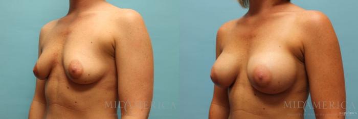 Before & After Breast Augmentation Case 125 View #2 View in St. Louis, MO