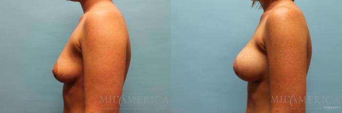 Before & After Breast Augmentation Case 125 View #3 View in St. Louis, MO