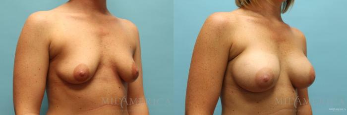 Before & After Breast Augmentation Case 125 View #4 View in St. Louis, MO