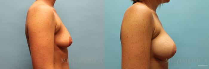 Before & After Breast Augmentation Case 125 View #5 View in St. Louis, MO