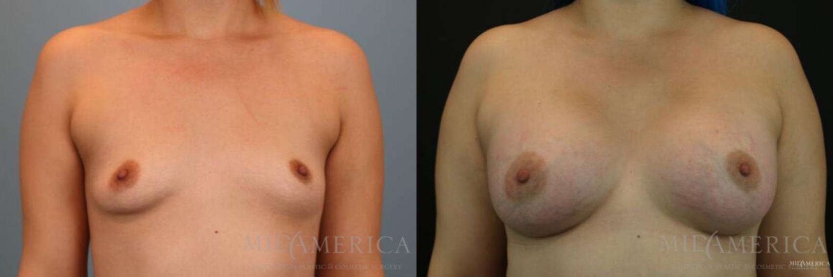 Before & After Breast Augmentation Case 129 View #1 View in Glen Carbon, IL